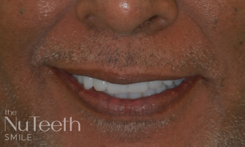 After treatment