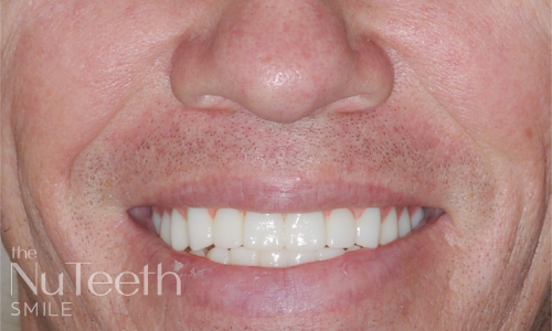 Patient smile after NuTeeth full arch implants
