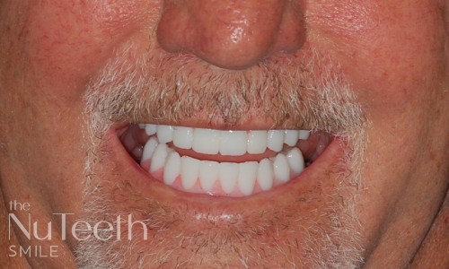 Patient smile after NuTeeth full arch implants