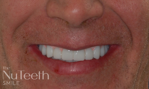 Patient smile after NuTeeth full arch implants