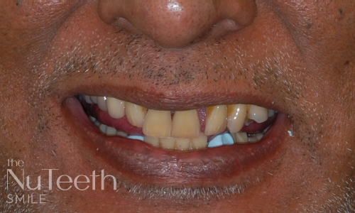 Before treatment