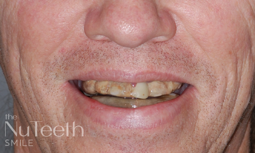 Patient smile before treatment