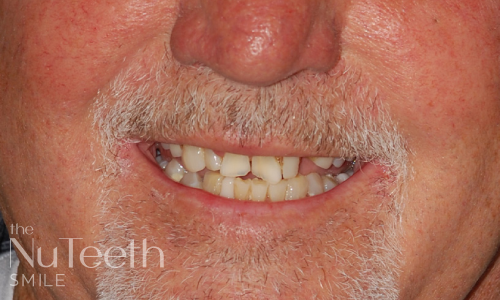 Patient smile before treatment