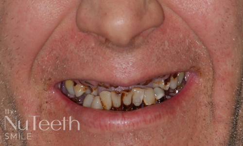 Patient smile before treatment